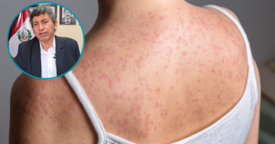 Arequipa reporta tercer caso importado de sarampión procedente de Puno con complicación respiratoria Arequipa reporta tercer caso importado de sarampión procedente de Puno con complicación respiratoria